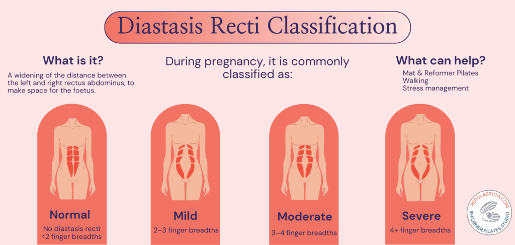 diastis recti classification