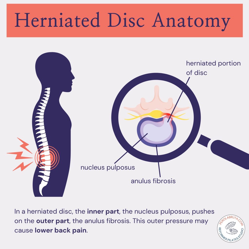 herniated disc anatomy