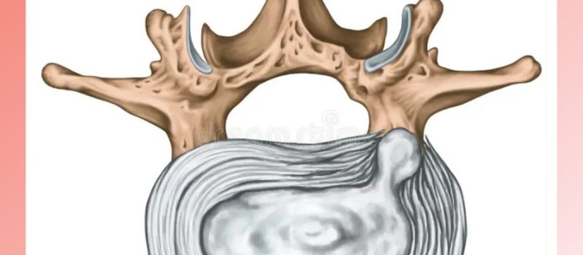 pilates for herniated disc